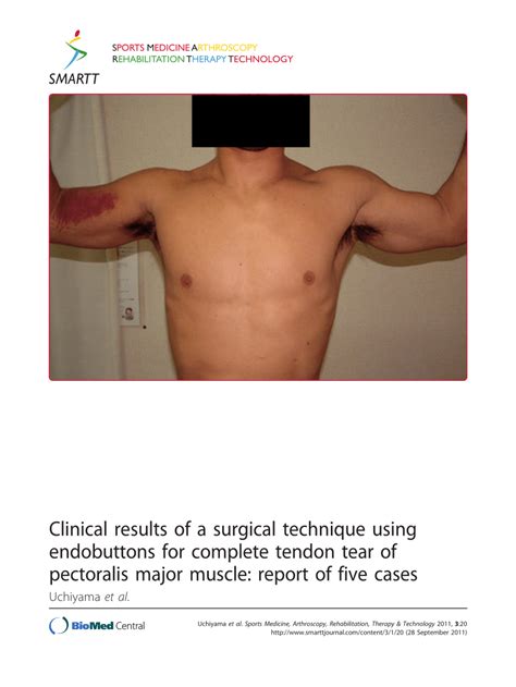 special tests used for pec major tears|pectoralis major repair.